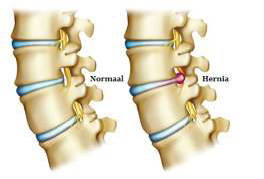 hernia skelet